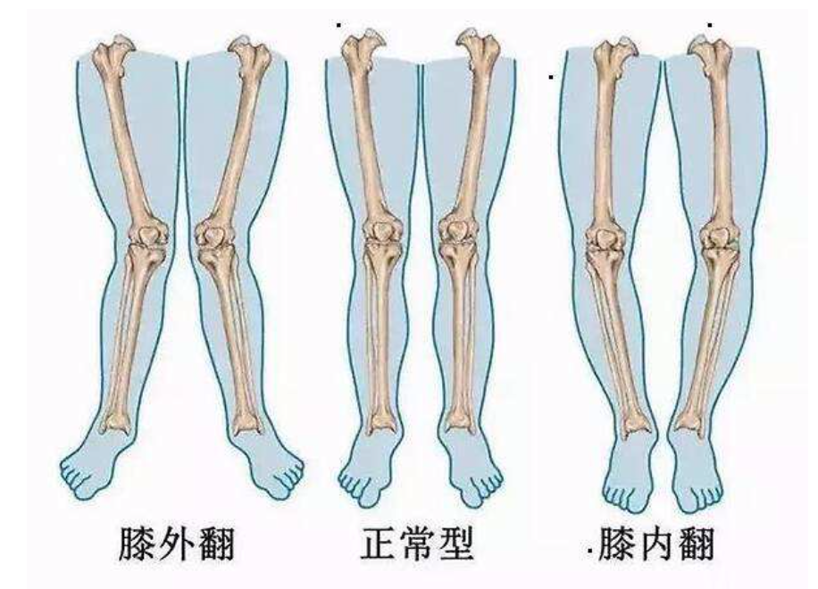 孩子o型腿,x型腿,八字脚,竟和这个疾病有关?