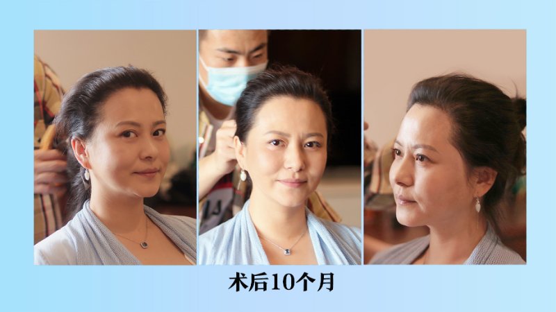 蝶变新生!齐鲁全民植发节活动启幕,为脱发的发友们带来福利