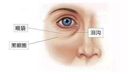 眼袋和泪沟如何区别,别再傻傻分不清
