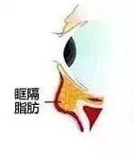 眼袋和泪沟如何区别,别再傻傻分不清