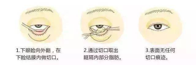 眼袋和泪沟如何区别,别再傻傻分不清