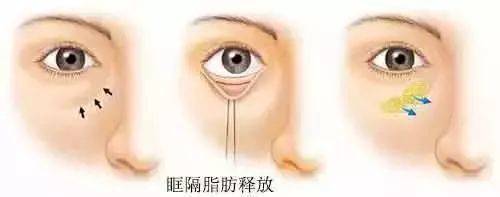 眼袋和泪沟如何区别,别再傻傻分不清