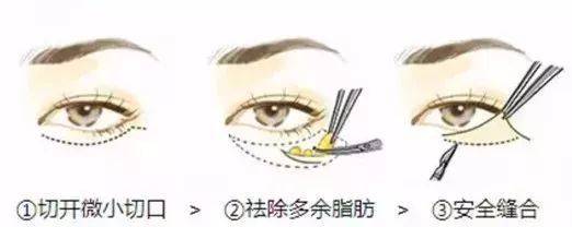 眼袋和泪沟如何区别,别再傻傻分不清