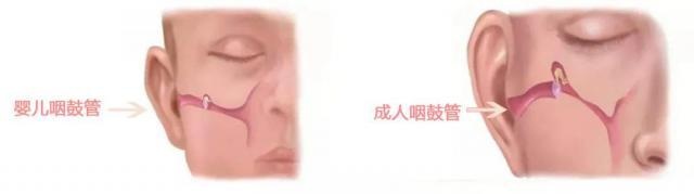 「儿童科普」 这病有点像感冒,其实却是中耳炎