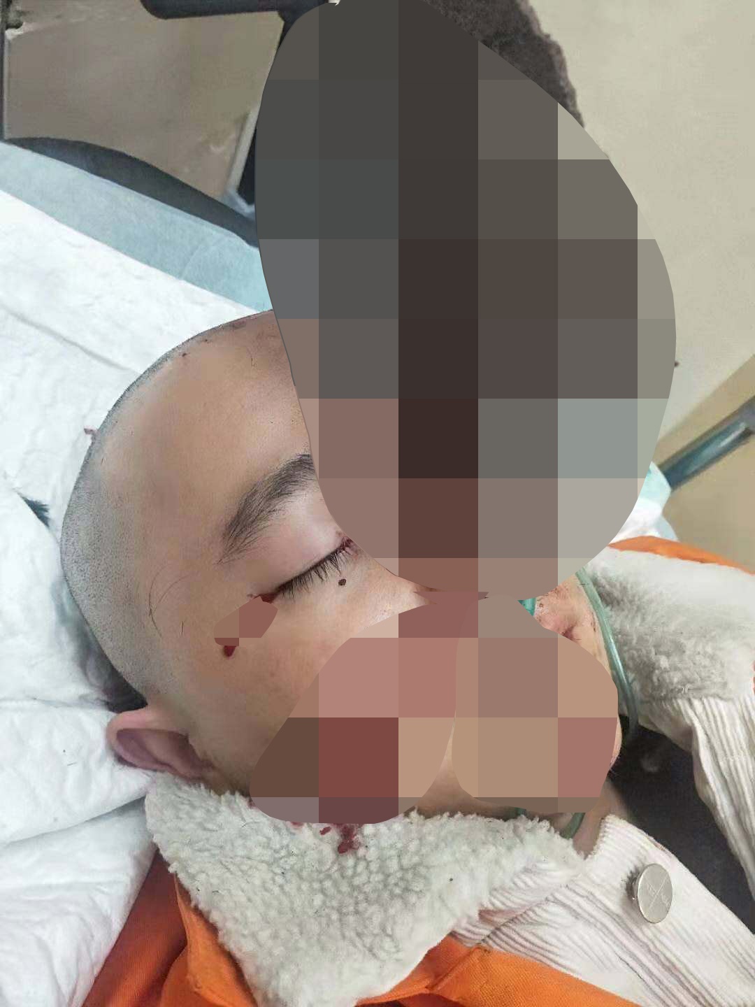 砂轮机炸裂残片直插工人颅内 老板:非工作时间出事