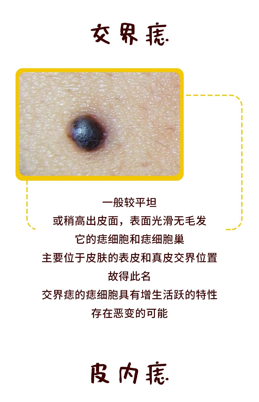 一颗平淡无奇的痣,竟然会癌变?