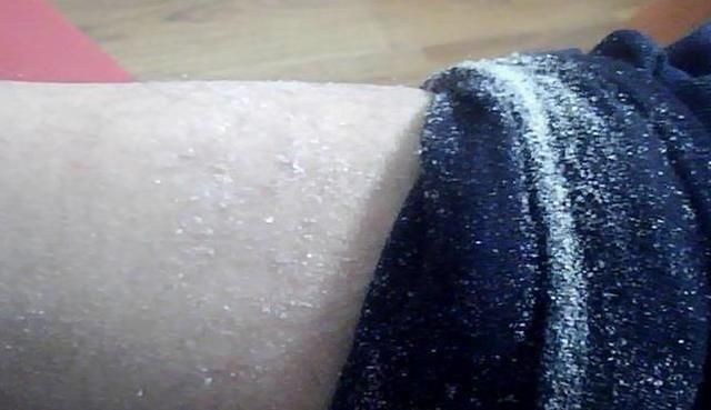 冬天干燥,腿上总有很多白色皮屑?是身体该补充这种维生素了!