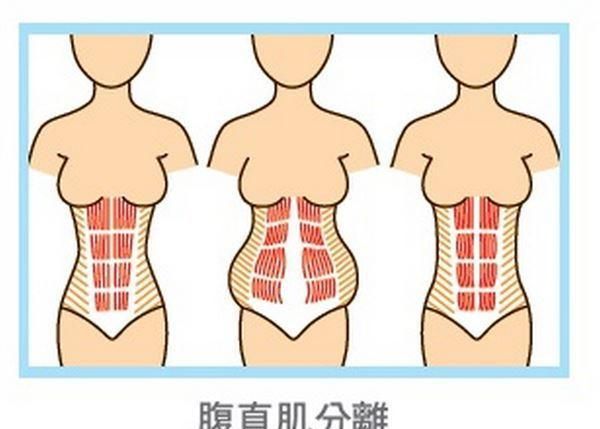 关注产后女性腹直肌分离超过3指还有恢复的可能吗