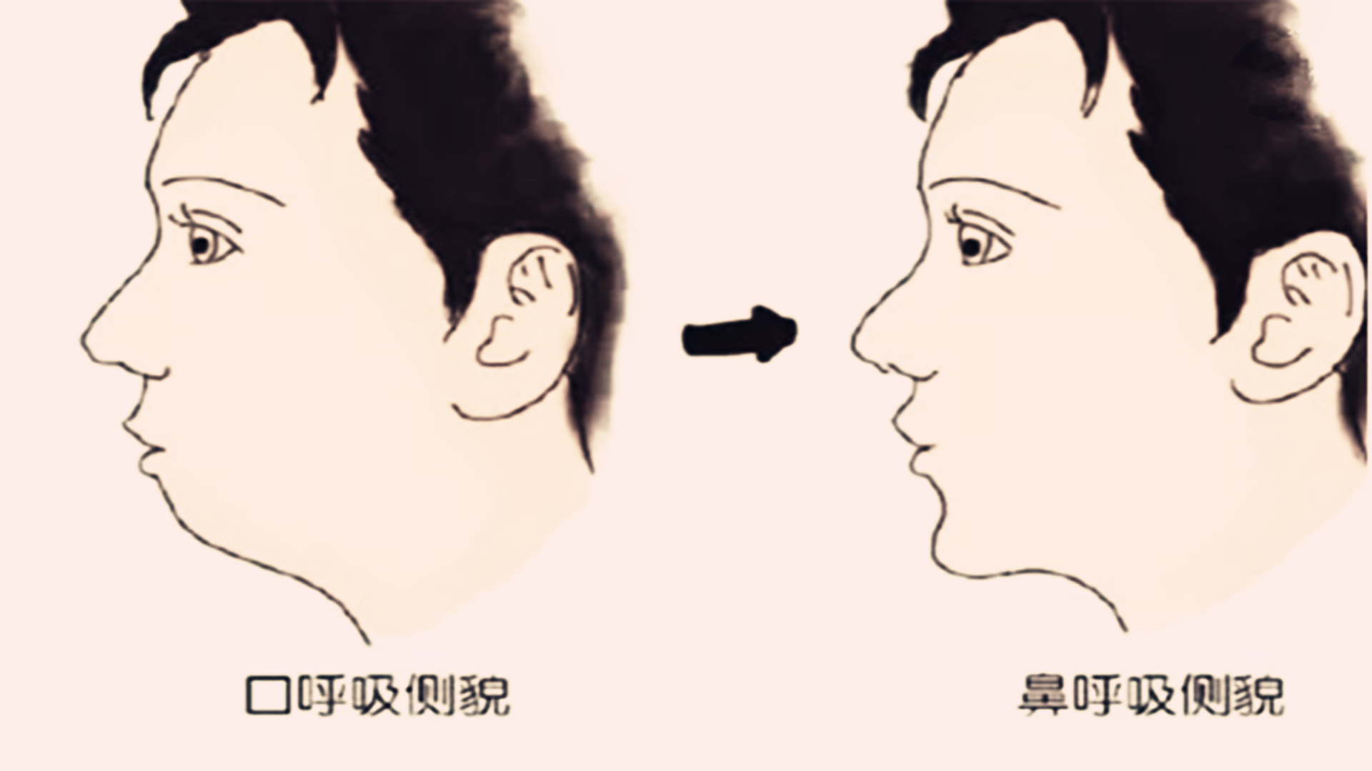 孩子小时候颜值高,长大后越长越丑,可能是父母这三种行为造成的