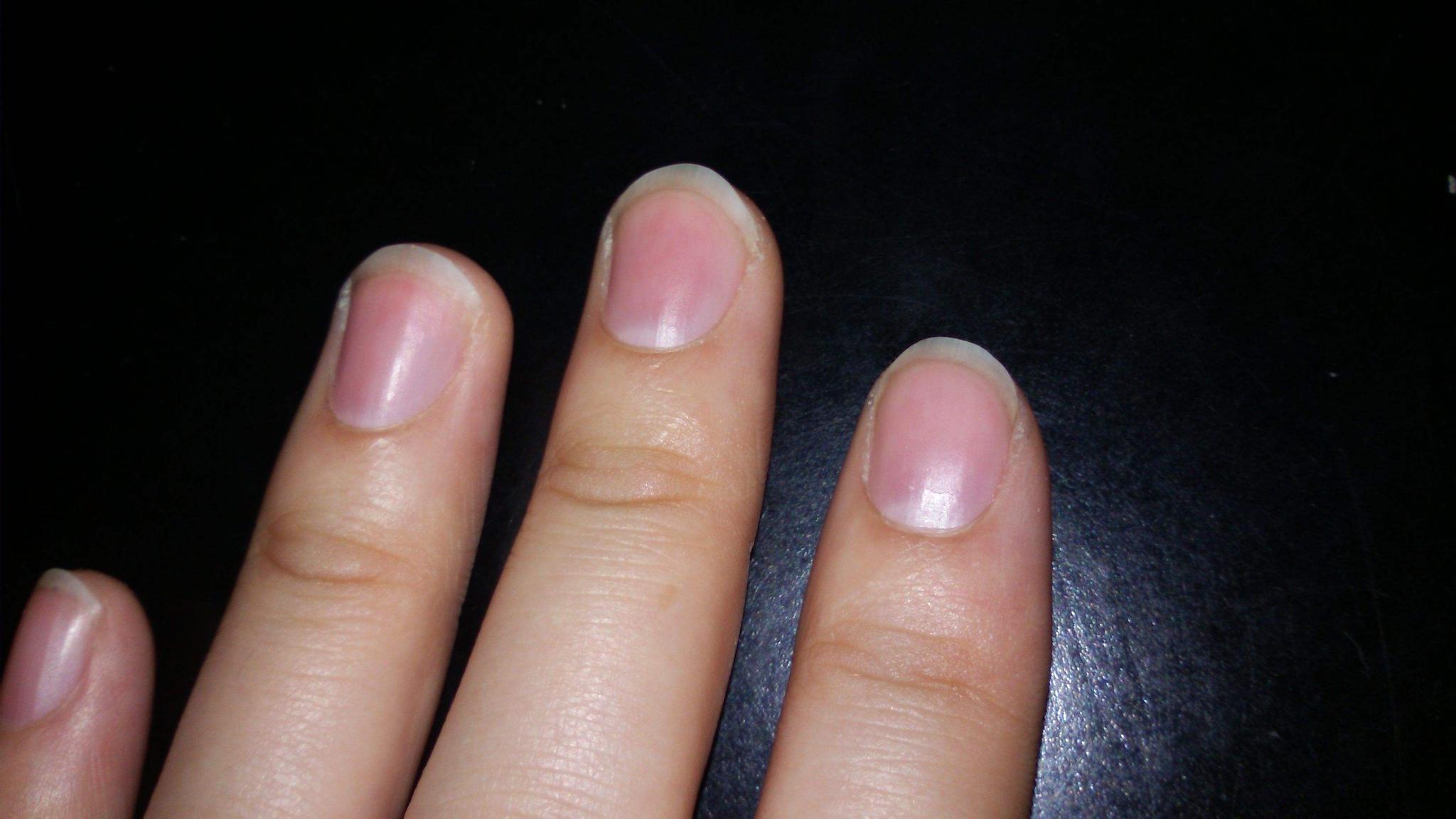 指甲反映的健康隐患，出现这9种指甲或是疾病征兆！_手机凤凰网