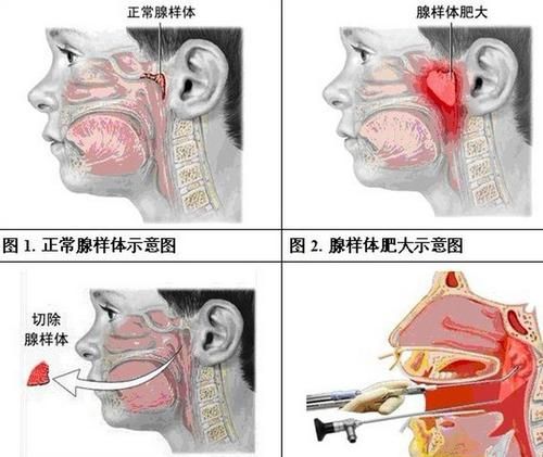 济南小儿推拿杨晓腺样体肥大是怎么回事中西医一般如何治疗