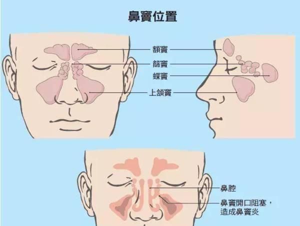 清鼻堂鼻健康中心:鼻炎,鼻窦炎傻傻分不清?三点教你正确辨别!