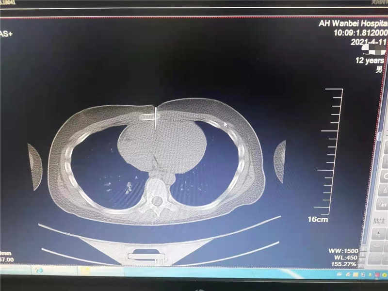 12岁男童玩气钉枪走火4cm钉子射入心脏