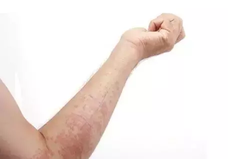 胳膊上起疹子怎么办?曼霜青蒿清肤霜让我重拾相亲的勇气