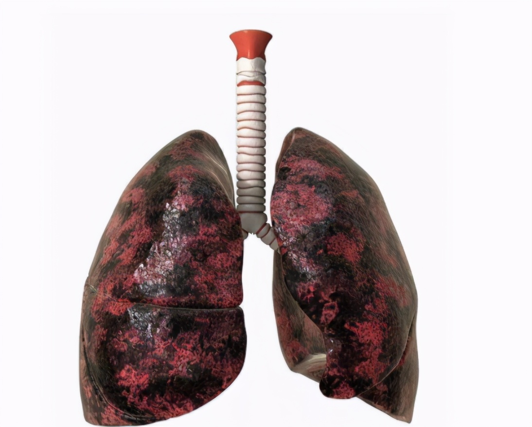 新冠肺炎患者肺部被病毒啃噬，肺功能不可恢复？ - 知乎
