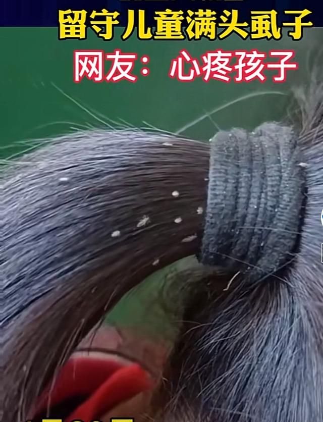 30年前男女老少都有虱子，为何现在没有了？虱子都是...