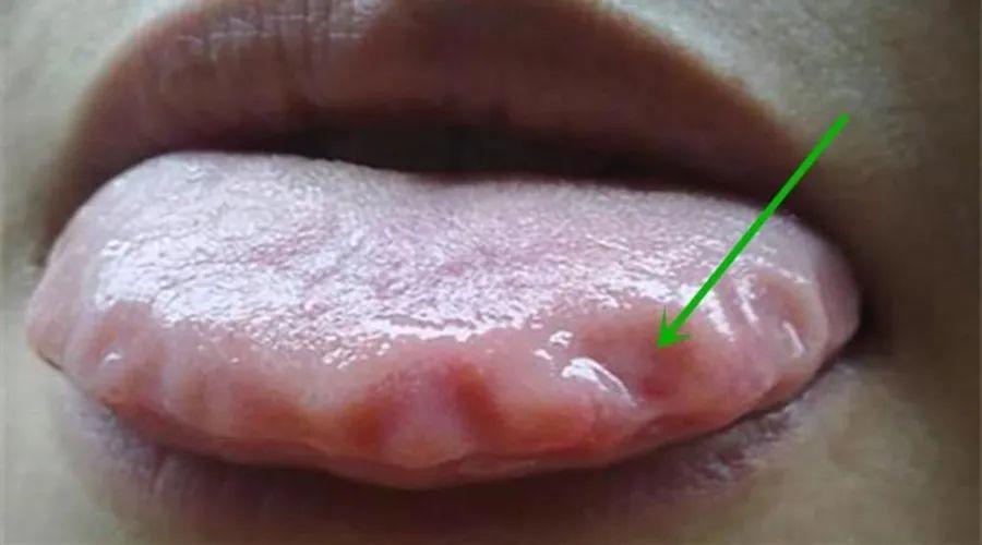 舌诊浅析:舌头有齿痕,舌面裂纹以及舌尖红点