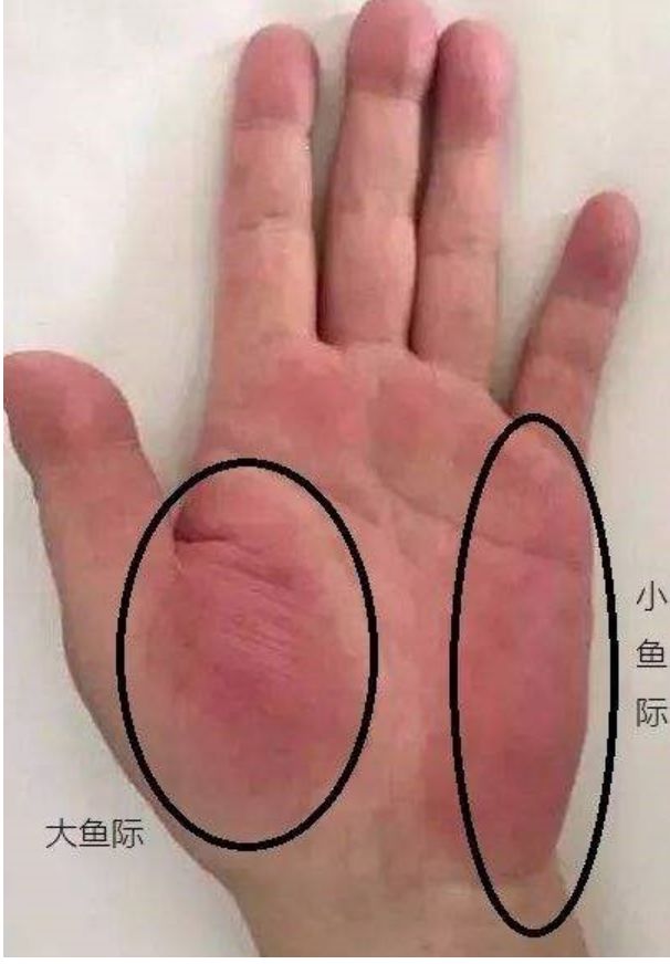 警惕！掌心潮红或暗藏肝脏危机：打工人肝损伤的五个阶段，详解每个阶段的症状表现和应对方法，助您保护肝脏，远离疾病困扰。