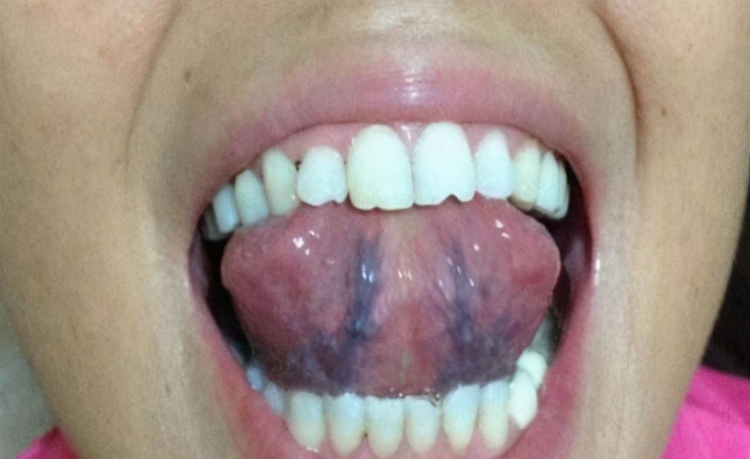 舌头下有青筋,是怎么回事,是心血管疾病的前兆