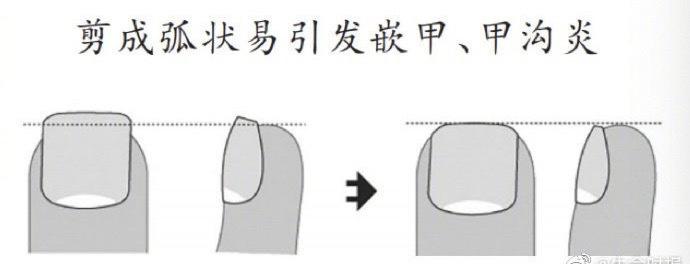 小脚趾甲分两瓣的来历 小脚趾分两瓣是纯种汉族人吗