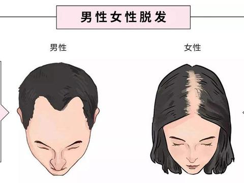 女性脱发了怎么办?