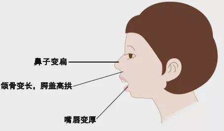 口呼吸不仅仅是会对人的面容产生影响,可能还会对身体健康和智力发展