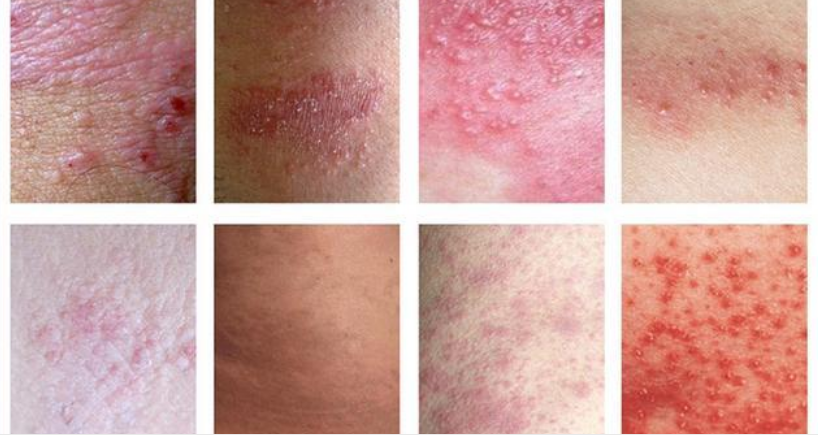 如果是慢性湿疹,不会出现红点或小水泡,但皮肤会变厚,表面会变得粗糙