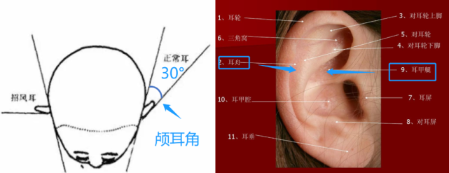 耳,扇风耳),是舟甲角,颅耳角过大,导致耳廓明显前倾,对耳轮发育不全