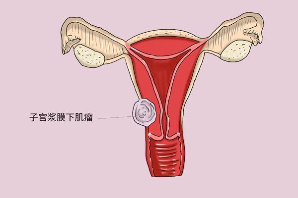 查出子宫肌瘤要不要切除？正在备孕，可以“带瘤”怀孕吗？