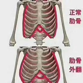 我们说的肋骨外翻,主要是指第7-10根肋骨向外突出,有时还伴有脊柱侧弯