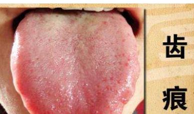 教你看舌苔颜色判断疾病,告别胃肠问题