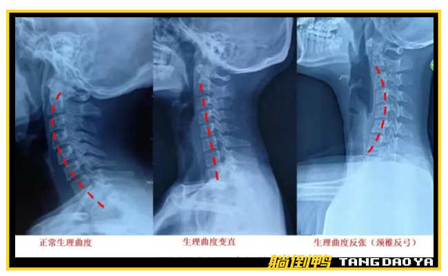 玩手机颈椎报废的年轻人正靠睡觉按摩救命