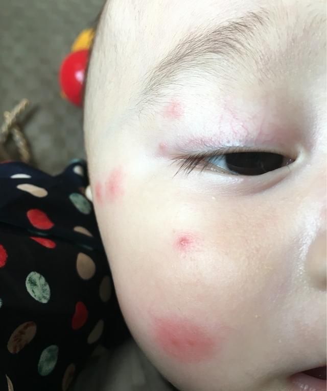 夏天蚊子增多,谨防宝宝被蚊子叮咬,家长要做好