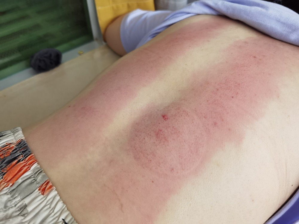 上班族的首选左点智能走罐刮痧器在家就能养生