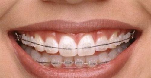 牙齿之间的牙缝很大怎么办,可以补吗?
