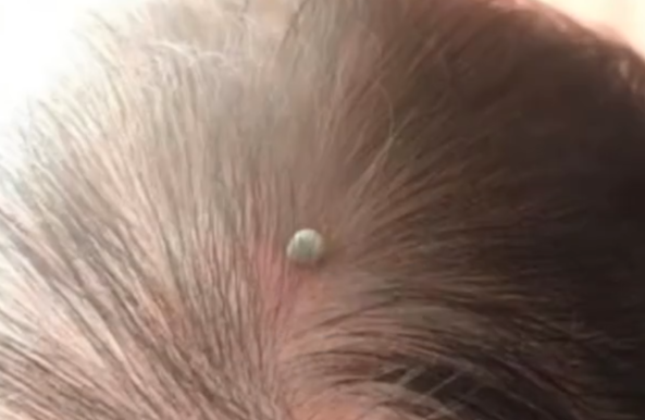 南昌出生仅4天婴儿被蜱虫咬伤 父亲:发现时头全部吸进去了