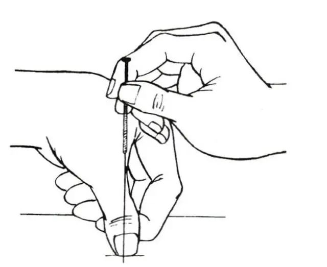 临床常用的毫针进针方法(精华版)|腧穴|针法|毫针