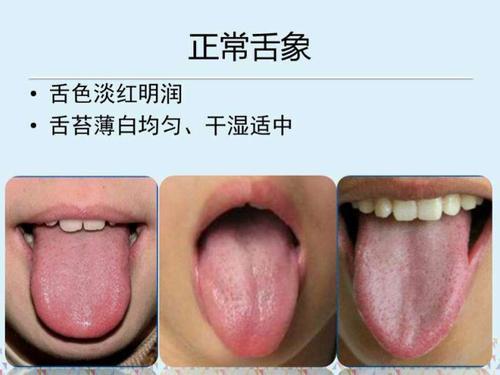 正常舌象可概括为六个字:淡红舌薄白苔.