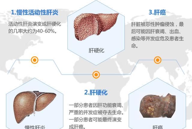求问正常体检能查出肝硬化吗