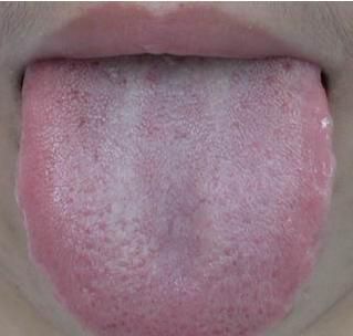 舌苔中间有裂纹是大病的征兆?辟谣:可能不是病理原因注意几点
