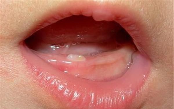 4到10个月宝宝,若出现几个症状,说明要长牙了,父母别忽略