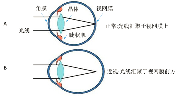 近视的原理(图:bostoneyeblink