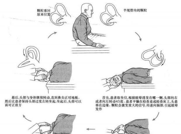 由lempert等于1996年设计的复位方法,一般用于治疗外半规管耳石症.
