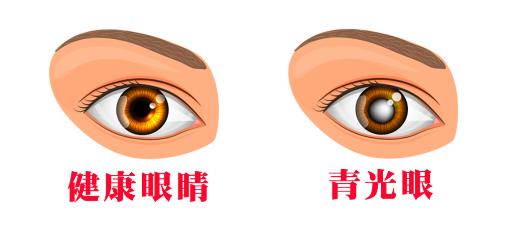 75患者发现时已至中晚期警惕视力小偷青光眼
