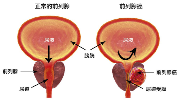 男性特有的忧虑——前列腺