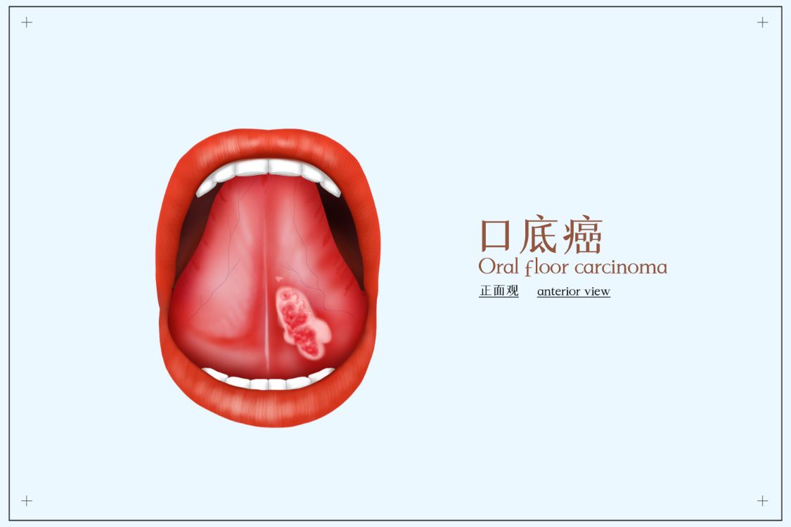 男性注意,嘴巴里也可能会感染hpv
