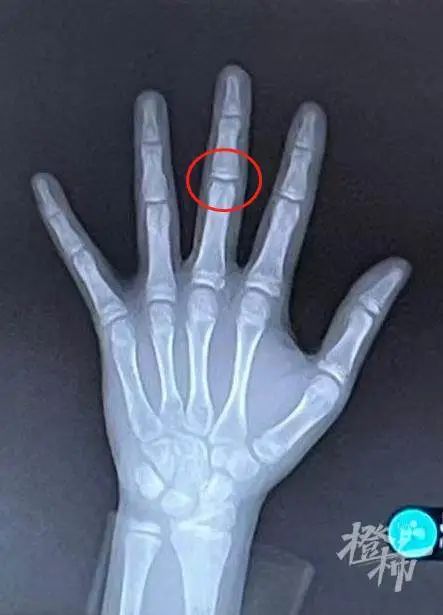 暑假"测骨龄"的娃乌泱泱!儿科专家提醒:要小心