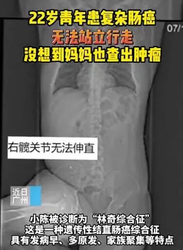 母亲带22岁儿子看病,母子竟被查出患同一种癌!这种癌要警惕!休闲区蓝鸢梦想 - Www.slyday.coM 母亲带22岁儿子看病,母子竟被查出患同一种癌!这种癌要警惕!休闲区蓝鸢梦想 - Www.slyday.coM