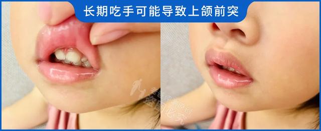 吃手,啃指甲,咬嘴唇…孩子的小癖好只能靠「苦甲水」来解决?