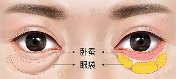 怎样去掉眼袋（怎样去掉眼袋小偏方）